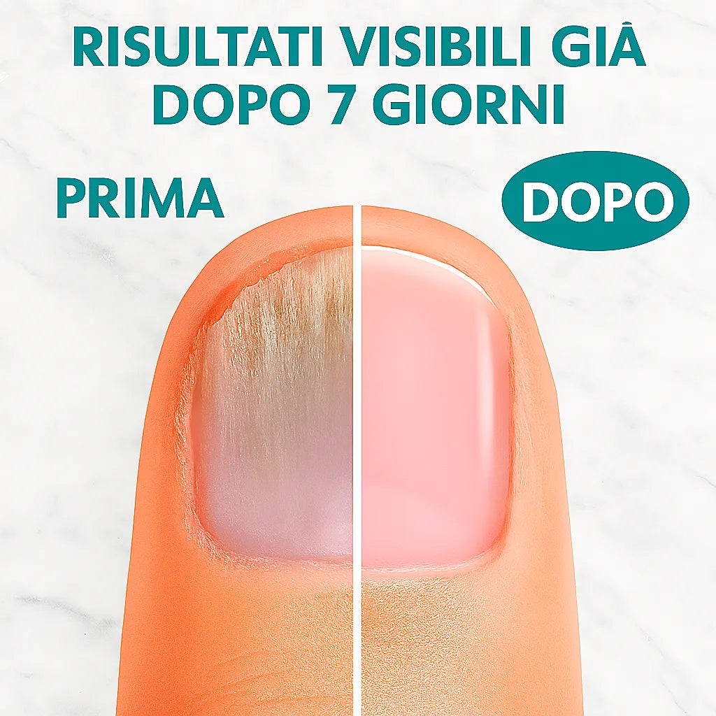 Soavia™ PureNails – Dimentica le unghie rovinate, ritrova la tua serenità